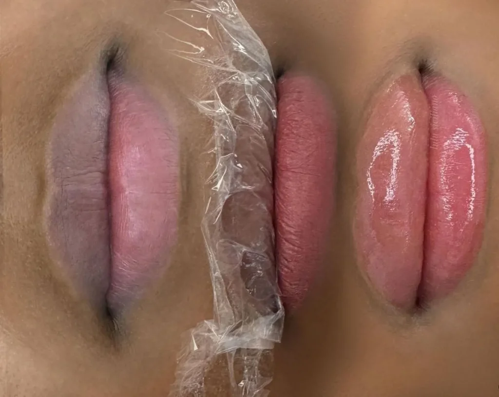 lip neutralization brisbane