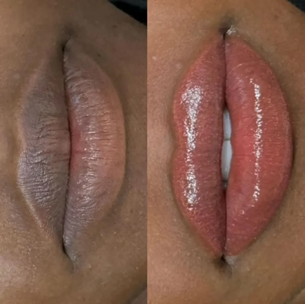 lip neutralization before and after